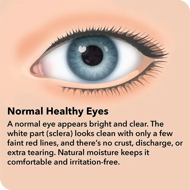 Pink Eye
