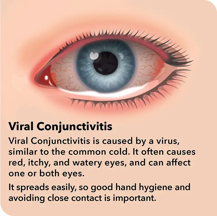 Pink Eye