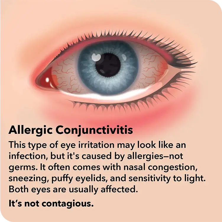 Pink Eye