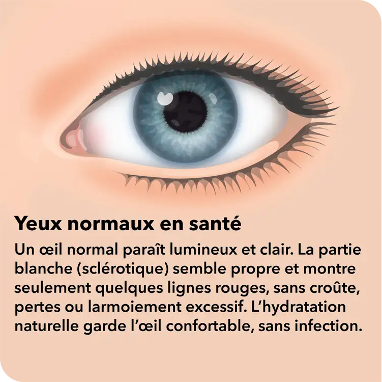 Pink Eye
