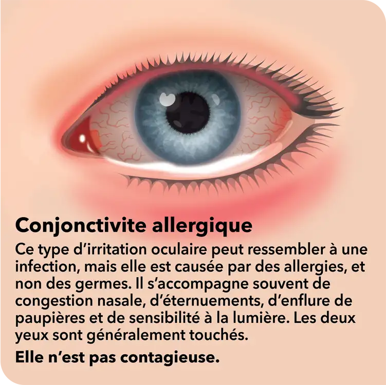 Pink Eye